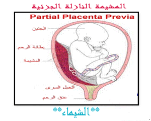مشكله هبوط المشيمة وحلها - كل ما تريدين معرفته لعلاج والوقايه من نزول المشيمه 20160714 162