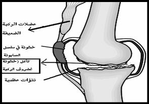 خشونة الركبة وعلاجها بالاعشاب - علاج الم خشونة الركبة طبيعي بدون جراحة 20160710 185