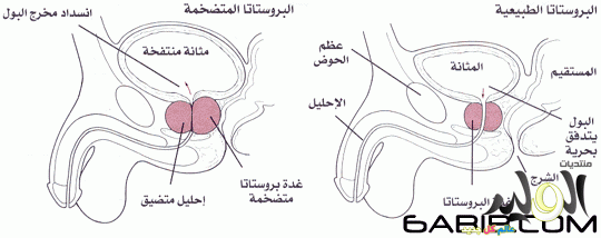 اسباب تضخم البروستاتا عند كبار السن - شوف السبب وعالج نفسك بسرعه 20160703 19