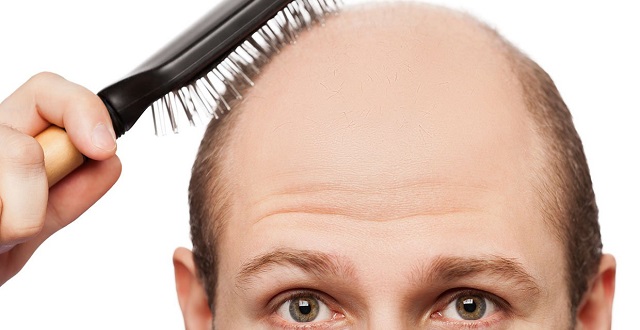 طريقة علاج صلع فعال - انهاء الصلع نهائيا Baldness Treatment