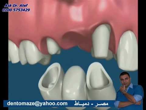 كيفية تركيب اسنان بورسلين 20160713 1085