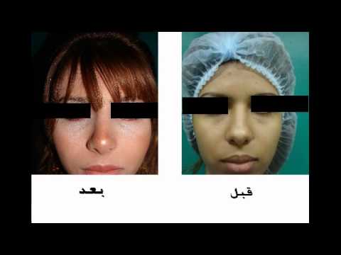 عملية تجميل انف في مصر 20160711 2148