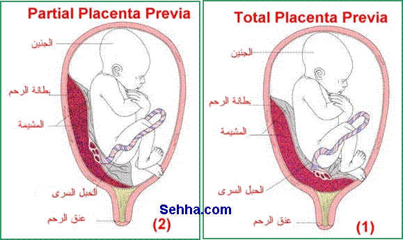 مشكله هبوط المشيمة وحلها - كل ما تريدين معرفته لعلاج والوقايه من نزول المشيمه 20160714 163