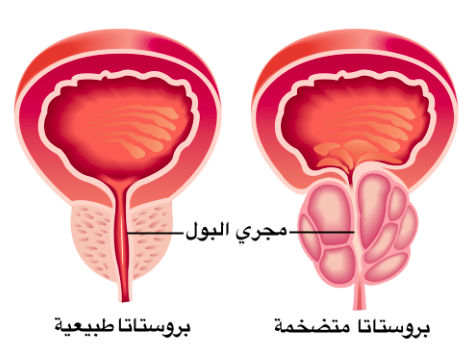 اسباب تضخم البروستاتا وعلاجه - سبب عدم القدرة على تبول عند الرجال 20160628 139