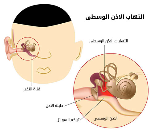 علاج التهاب الاذن الوسطى بزيت الزيتون 20160622 127