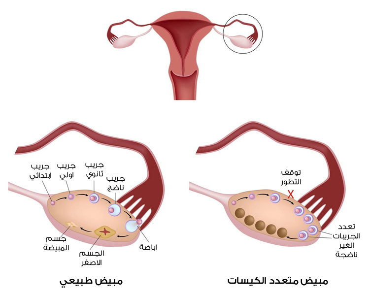 الم في المبيض اسبابه وطرق علاجه 20160620 589