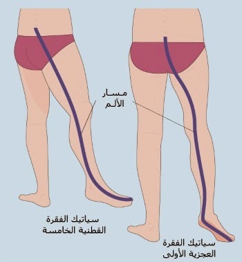 كيفية علاج عرق النسا بالاعشاب 20160714 1734