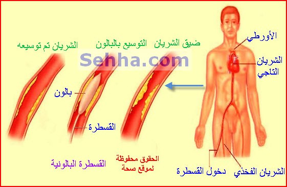انسداد الشرايين في القلب - ملف كامل عن انسداد الشرايين والاوردة 20160703 1600