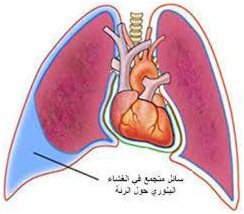 ما اسباب تجمع الماء على الرئة - علاج حالات ياس منها الطب 20160630 1992