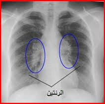 ما اسباب تجمع الماء على الرئة - علاج حالات ياس منها الطب 20160630 1994