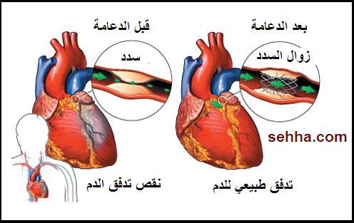 انسداد الشرايين في القلب - ملف كامل عن انسداد الشرايين والاوردة 20160624 234