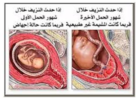 خروج الدم اثناء الحمل - انا حامل ونزل عليا حجات ايه معناها 20160625 170