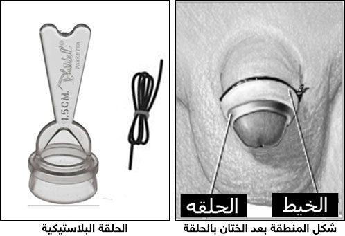 ختان الطفل بالحلقة البلاستيكية 20160628 2095