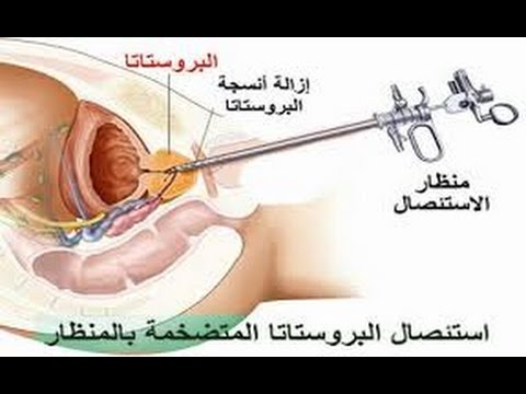 اعراض التهاب البروستاتا البسيط 20160713 1510