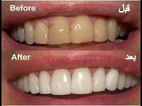 علاج طبيعي لتبيض الاسنان - فعال بطريقة لن تصدق للتفتيح بسرعة 20160709 859