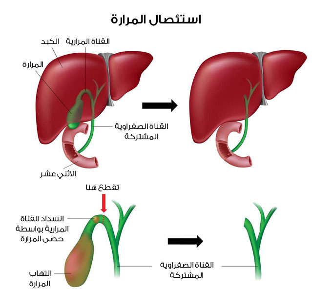 هل استئصال المراره يؤثر على الحمل 20160629 2348