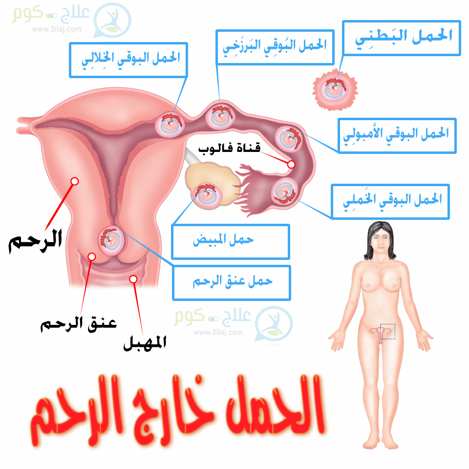 اسباب الحمل خارج الرحم 20160717 40