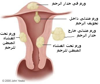 الورم الليفي في الرحم وعلاجه بالاعشاب 20160712 432