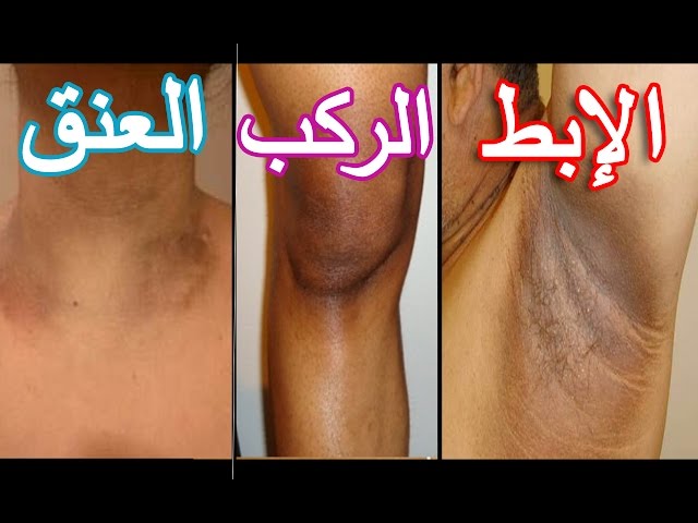 ركبي بقت فاتحة جدا , اسرع طريقة لتبيض الركب