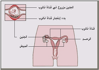 حمل خارج الرحم بدون اعراض 20160701 136