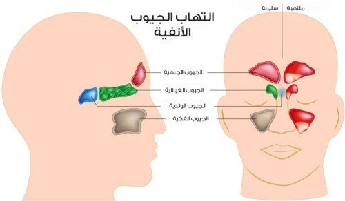 افضل دواء لحساسية الجيوب الانفية - الحل المثالي لحساسيه الجيوب الانفيه 20160718 768