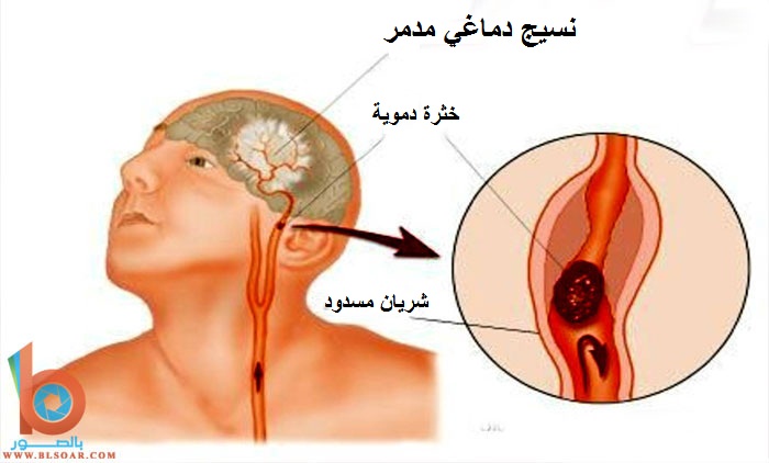 صور اضرار التدخين - خلفيات لكل شخص مصر على التدخين 20160630 809