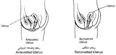 تفاصيل عن الرحم المائل 20160714 2264