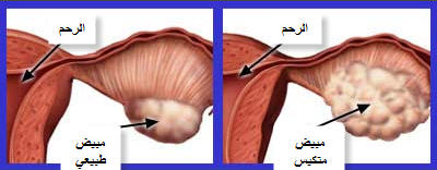 التكيس كنت حاسة أن عندى تكيس وطلع فعلا موجود - اعراض متلازمة تكيس المبايض