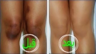 الركب بقت بتلمع منها - خلطة لتبيض الركب في يوم Mqdefault