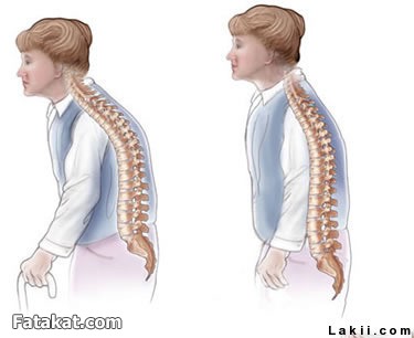 ما هو سبب انحناء الظهر , نصائح لضمان سلامه العمود الفقري