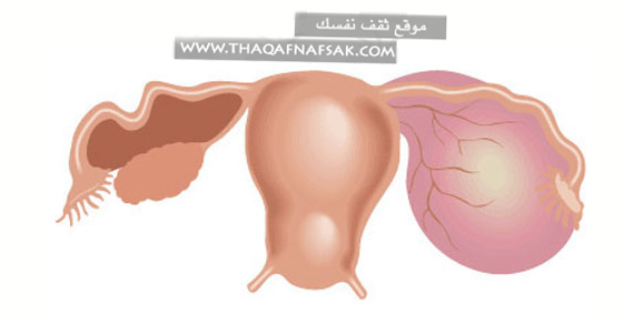 فوائد واضرار عملية ثقب المبايض - معلومة طبيه تهم كل سيدة 20160706 60