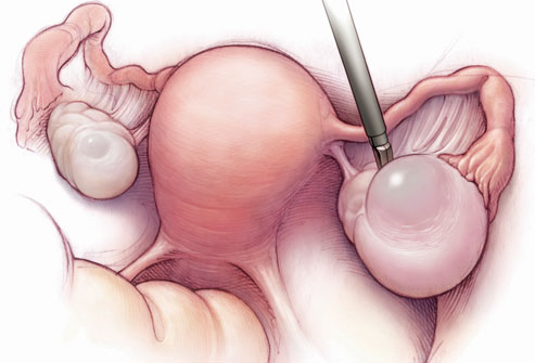 معلومات اسباب تضخم المبيض Phototake Rm Photo Of Ovarian Cysts1