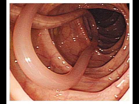 اشكال الدود في البطن