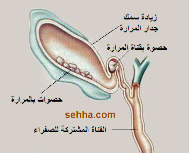 حصوات المراره واعراضها وطرق التخلص منها 20160702 471