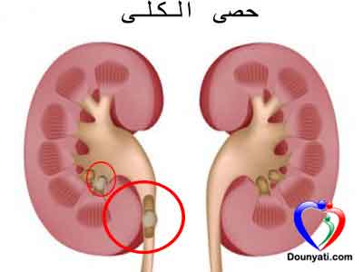 كيف اتخلص من رمل الكلى - الاسباب الشائعة لتلف الكلى Kidney Stone