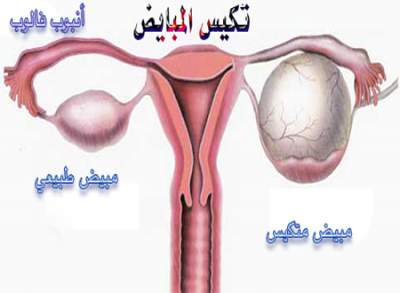 التكيس كنت حاسة أن عندى تكيس وطلع فعلا موجود - اعراض متلازمة تكيس المبايض 20160705 1441