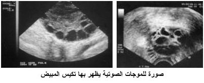 تكيس المبايض البسيط عند السيدات - اشياء بسيطة لا تضر 20160715 1697
