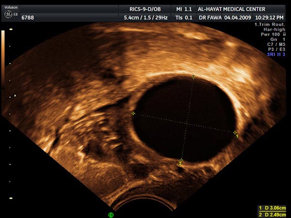 كيس ماء في الرحم اثناء الحمل 20160620 464