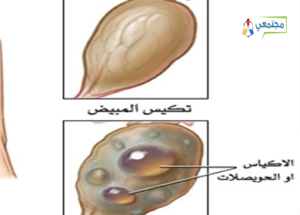 تكيس المبايض البسيط عند السيدات - اشياء بسيطة لا تضر 20160715 114