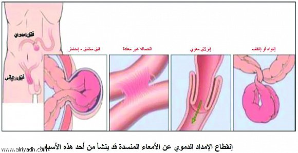 الم شديد في البطن بعد الاكل- تعرف على أنواع المغص كي تتناول الدواء الصحيح 20160628 742