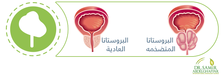 اسباب تضخم البروستاتا عند كبار السن - شوف السبب وعالج نفسك بسرعه 20160703 65