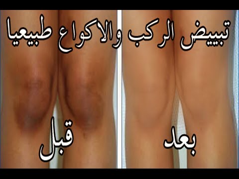 الركب بقت بتلمع منها - خلطة لتبيض الركب في يوم Hqdefault 20 1