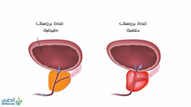 مرض تضخم البروستاتا وعلاجها - للرجال فقط لا تخف لها حلول سريعة 20160701 146