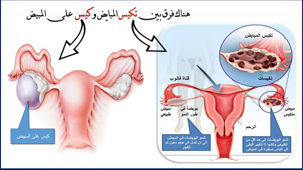 ما الفرق بين الكيس والتكيس - تكييس المبيض وما يمنع الحمل واسبابه وتفاصيله 20160726 20