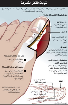 اسهل علاج فطريات الاظافر 20160726 48