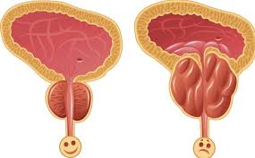 مرض تضخم البروستاتا وعلاجها - للرجال فقط لا تخف لها حلول سريعة 20160701 2171