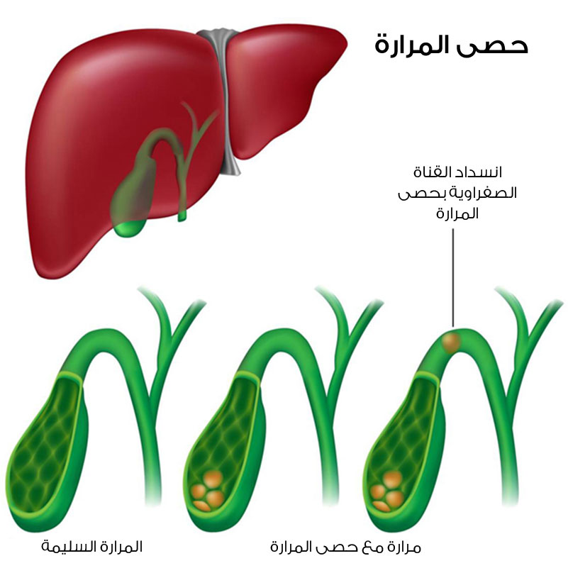 هل استئصال المراره يؤثر على الحمل 20160629 2347