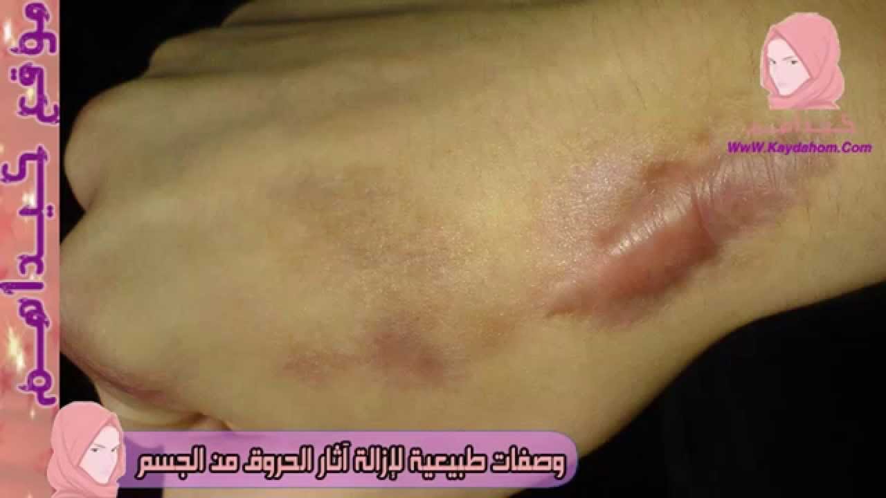 خلطات ووصفات لازالة اثار الحروق - وصفة لازالة الحروق البسيطة 20160716 1092