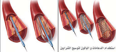 انسداد الشرايين في القلب - ملف كامل عن انسداد الشرايين والاوردة 20160624 235