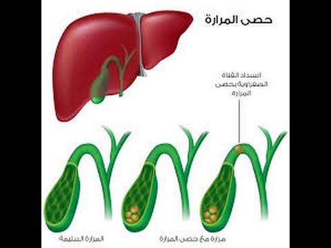 علاج حجر المرارة بالاعشاب - علاج بالاعشاب الطبيعيه هيجيب من الاخر معاكوا 20160626 2275